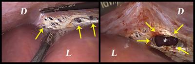 A bird-eye view of diaphragmatic endometriosis: current practices and future perspectives